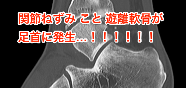 1週間入院して関節遊離体と骨棘除去のための関節鏡手術を受けてきました 痛い写真あり 1週間入院して関節遊離体と骨棘除去のための関節鏡手術を受けてきました 痛い写真あり